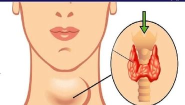 این نشانه ها می گوید که غده تیروئید شما کار نمی‌کند
