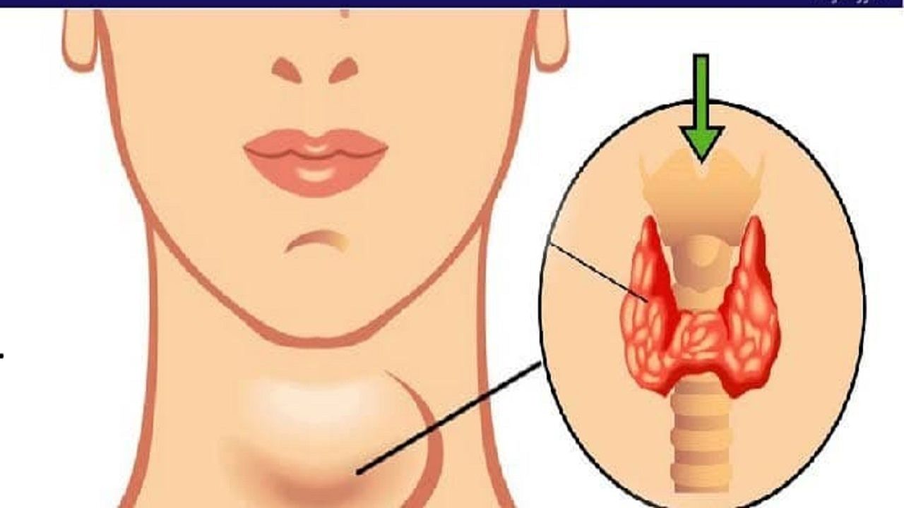 این نشانه ها می گوید که غده تیروئید شما کار نمی‌کند
