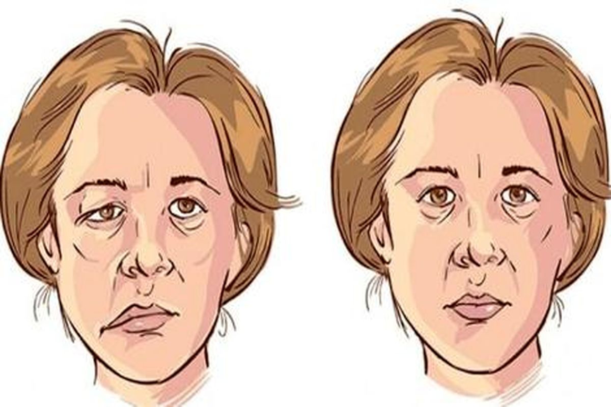 ​اختلالی که در زنان بالای 40 سال شایع تر است و سمت چپ صورت را درگیر می کند 