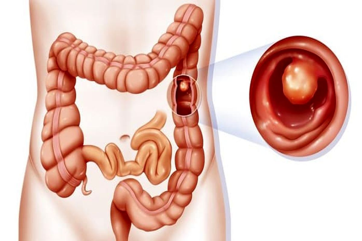 این افراد بیشتر سرطان روده می‌گیرند
